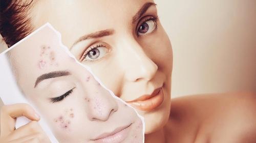 Limpieza facial anti-acne