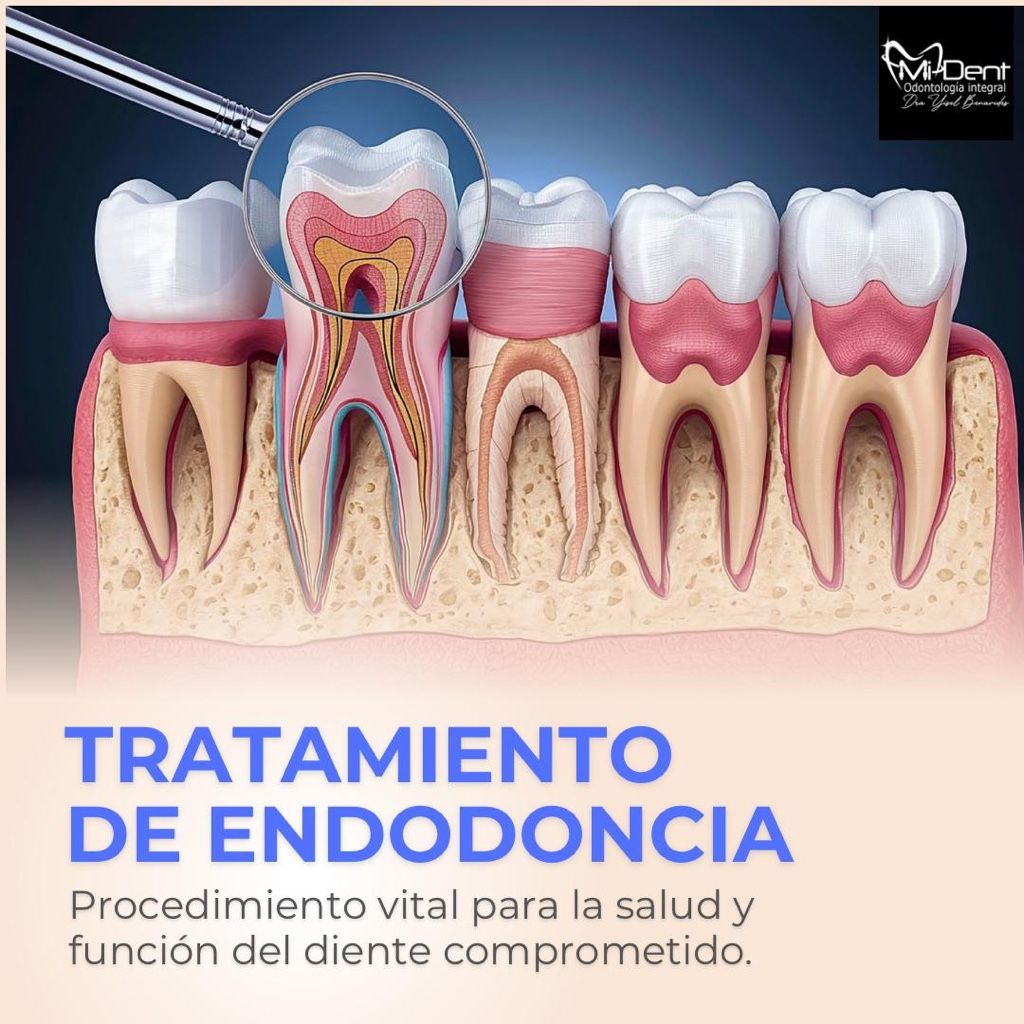 ENDODONCIA MULTIRADICULAR
