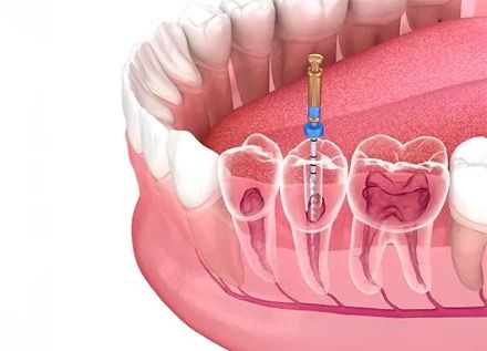 Endodoncia uniradicular